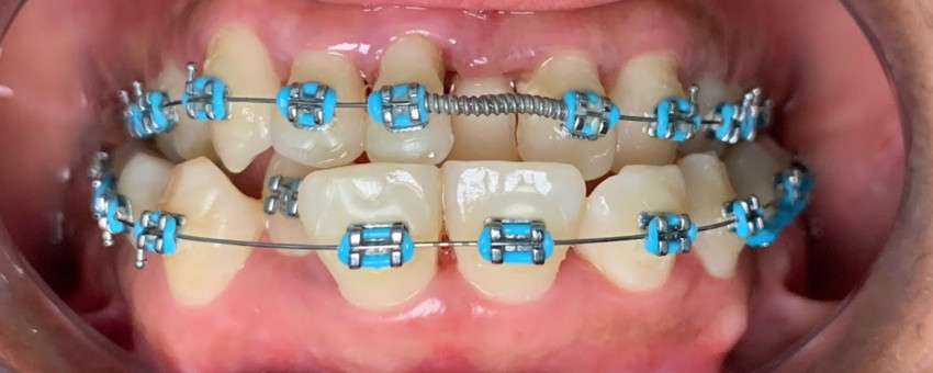 porcelain crown replacement kutuh bali