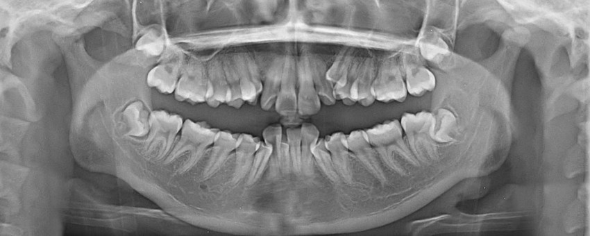 The Ultimate Restoration Strength: A Guide to Durable Zirconia Crowns Jimbaran Bali Services