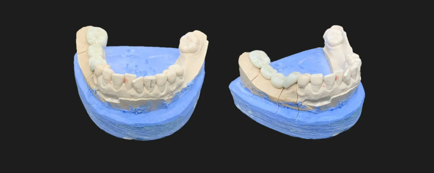 permanent tooth capping kampial kuta selatan